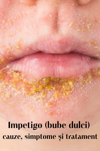 Impetigo (bube dulci) : cauze, simptome și tratament 109 Bube dulci cauzesimptome tratament uai