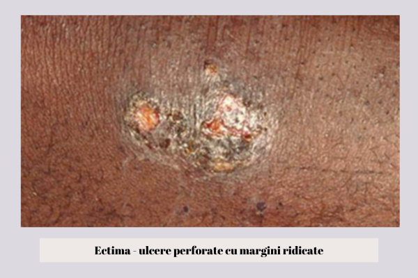Ectima ulcere perforate