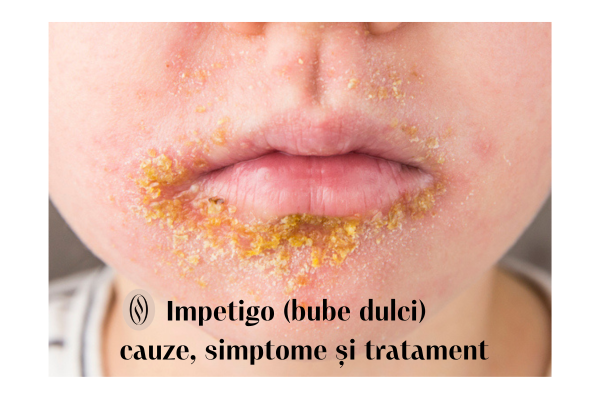 Impetigocauze simptome tratament
