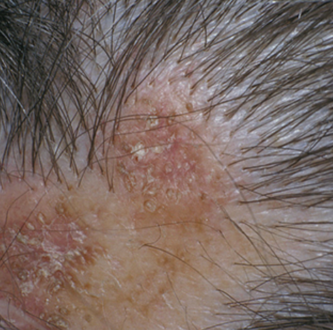 alopecie cicatriciala pierderea parului permanenta
