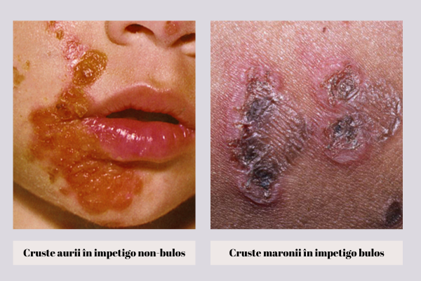 cruste in impetigo