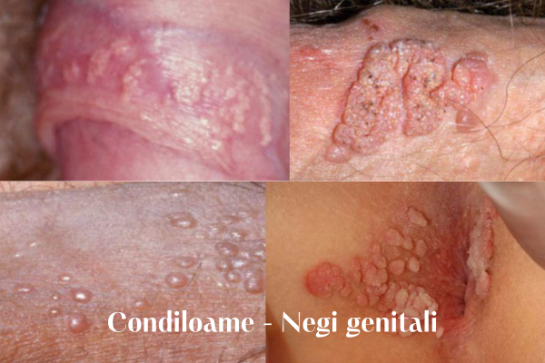 Virusul HPV : Transmitere, Leziuni și Prevenire 3 Condiloame negi genitali
