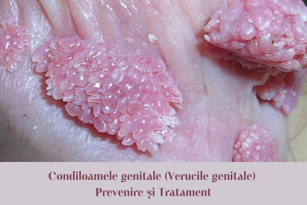 Verucile genitale (Condiloame genitale)- prevenire și tratament 1 Condiloamele genitale negi genitali poza