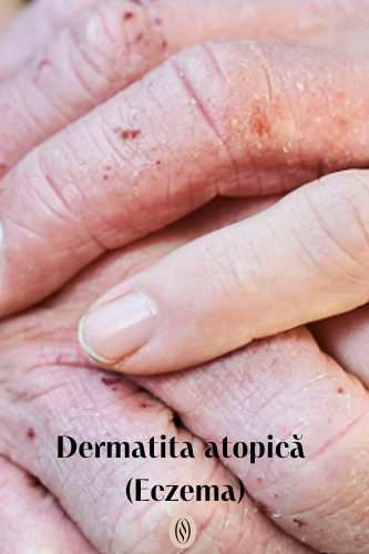 Dermatita atopică (Eczema) 97 Dermatita atopica Eczema uai