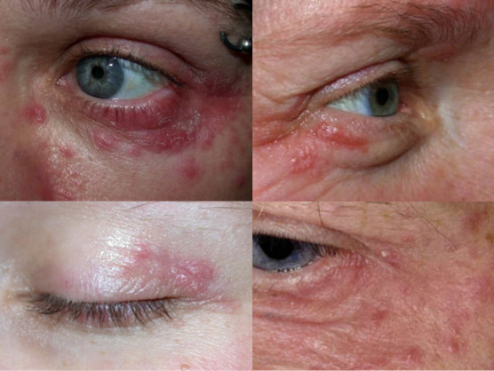 Dermatita periorală (DPO) 5 Dermatita periorificiala localizata periocular poza