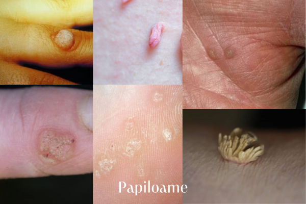 Virusul HPV : Transmitere, Leziuni și Prevenire 2 Papiloame poza
