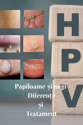 Papiloame și Negi : Diferențe și Tratament 99 Papiloame si negi Diferente si Tratament uai