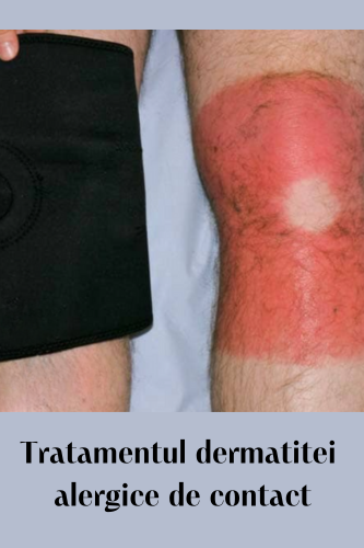 Tratamentul dermatitei alergice de contact 104 Tratamentul dermatitei alergice de contact uai
