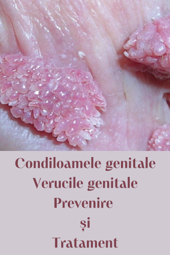 Verucile genitale (Condiloame genitale)- prevenire și tratament 101 Verucile genitale Condiloame genitale prevenire si tratament uai