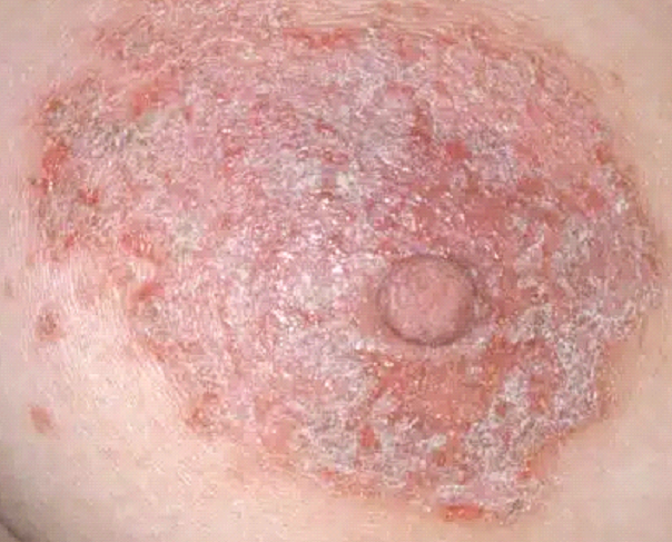 dermatita atopica la nivelul mameloanelor