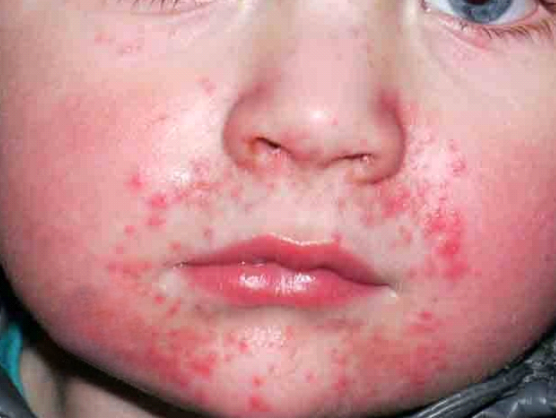 dermatita periorala copii