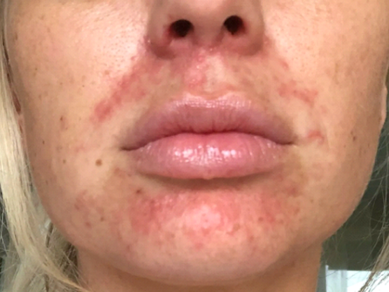 Dermatita periorală (DPO) 3 dermatita periorala poza