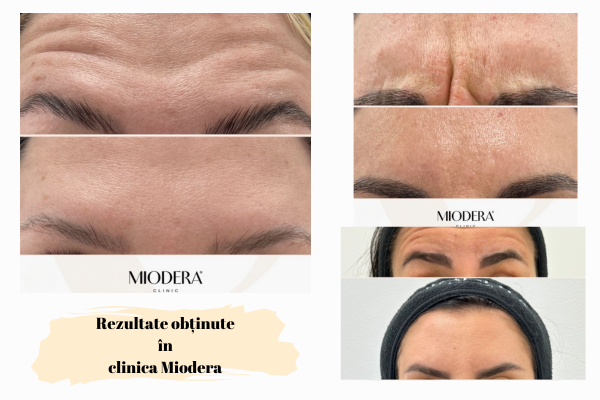Botox - injecții botox,utilizare și recomandări 2 injectii botox rezultat