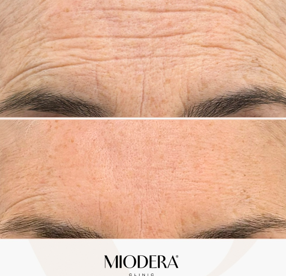 Botox - injecții botox,utilizare și recomandări 4 toxina frunte