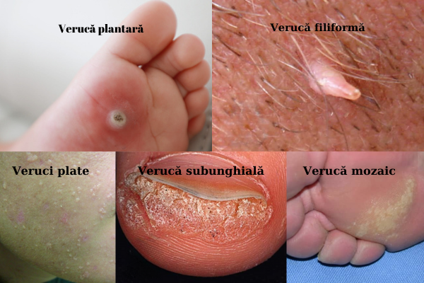 Virusul HPV : Transmitere, Leziuni și Prevenire 4 veruci negi papiloame