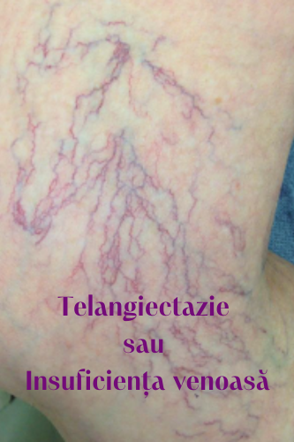 Telangiectazie sau Insuficiența venoasă 87 Telangiectazie insuficienta venoasa cronica 1 uai