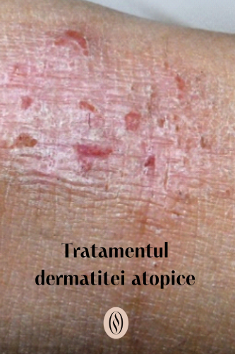 Tratamentul dermatitei atopice 95 Tratamentul dermatitei atopice 1 uai