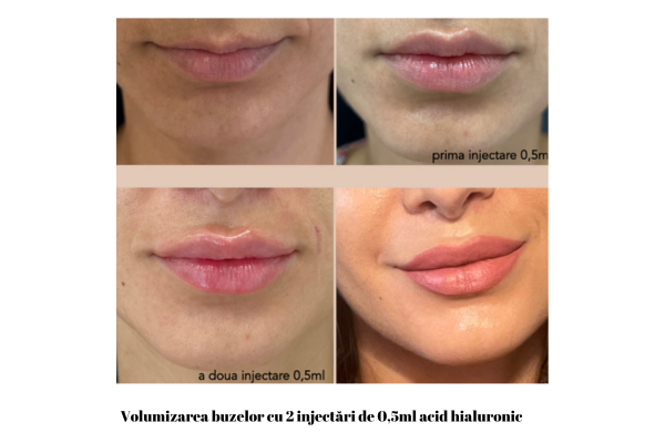 Volumizarea buzelor cu 2 injectari de 05ml