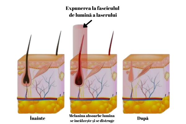 Epilarea definitivă cu laser 3 cum actioneaza laserul
