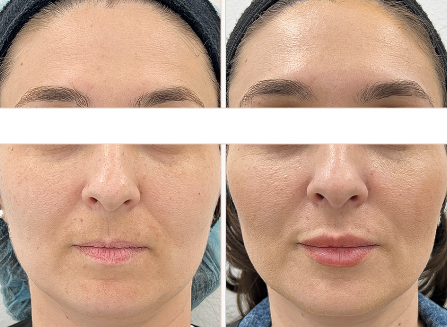 injectare buze cu acid hialuronic