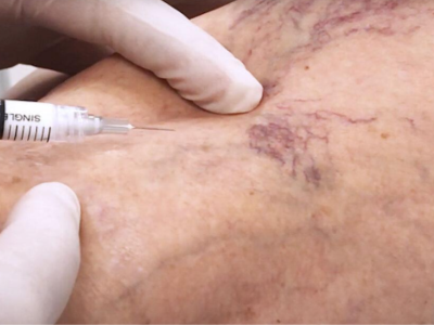 Telangiectazie sau Insuficiența venoasă 6 scleroterapia in telangiectazie