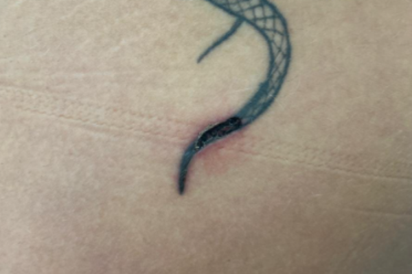 tatuaj ars cu laser