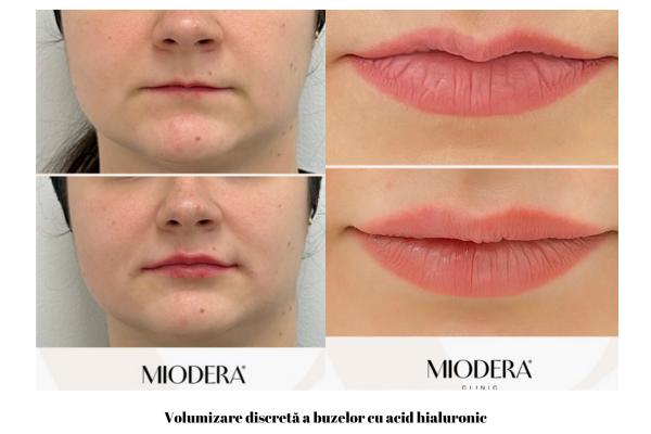 volumizarea discreta a buzelor cu acid hialuronic