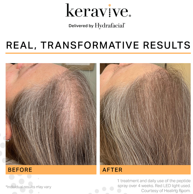 Hydrafacial Syndeo: Revitalizare Imediată 5 Hydrafacial scalp matur