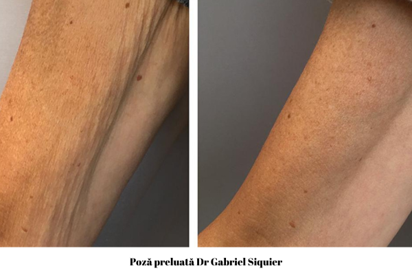 Profhilo Body pentru Fermitatea și Elasticitatea Pielii 5 Profhilo Body brate