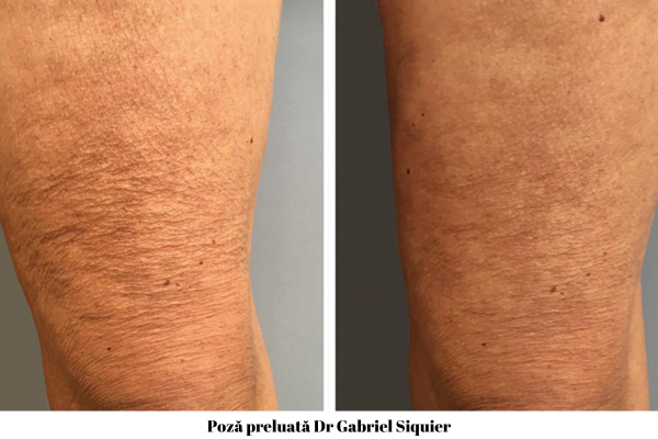 Profhilo Body pentru Fermitatea și Elasticitatea Pielii 6 Profhilo Body coapse