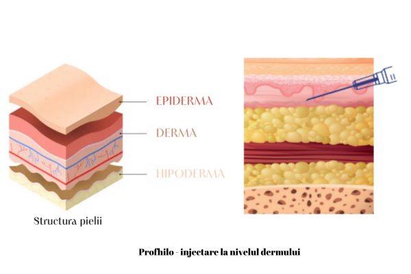 Profhilo injectare in derm