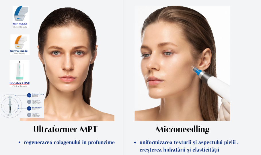 Ultraformer MPT si microneedling