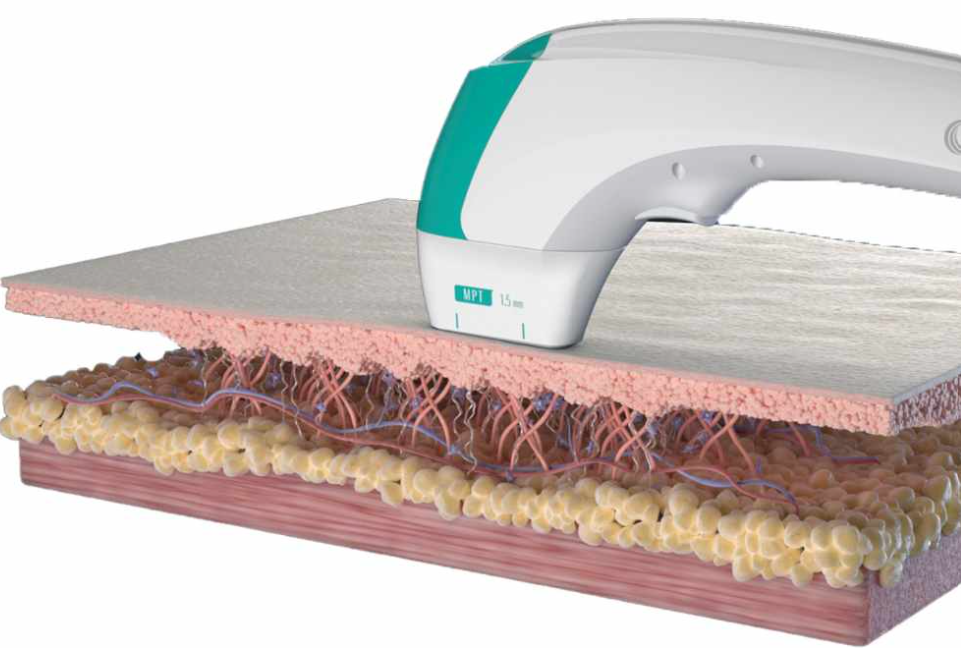 Ultraformer cap aplicator