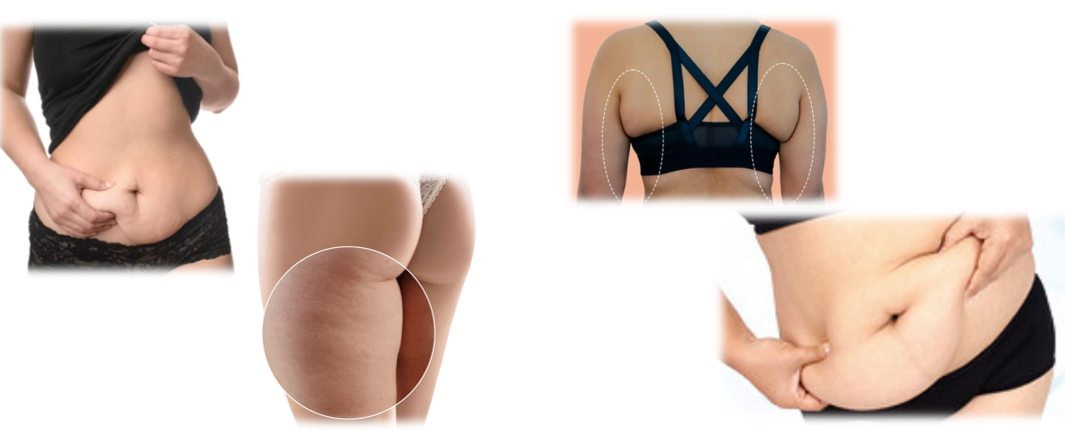 beneficii ultraformer
