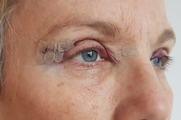 Blefaroplastia