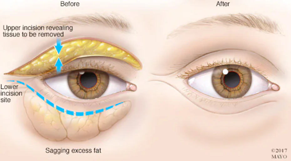 blefaroplastia
