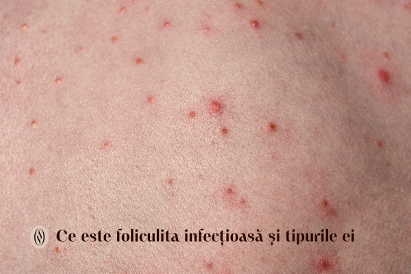 Ce este foliculita infecțioasă și tipurile ei 1 Ce este foliculita infecțioasă și tipurile ei