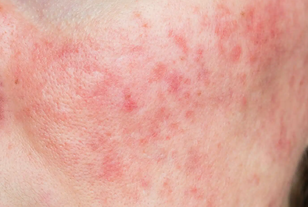 Ce este foliculita infecțioasă și tipurile ei 11 Foliculită cu Demodex și Rozacee