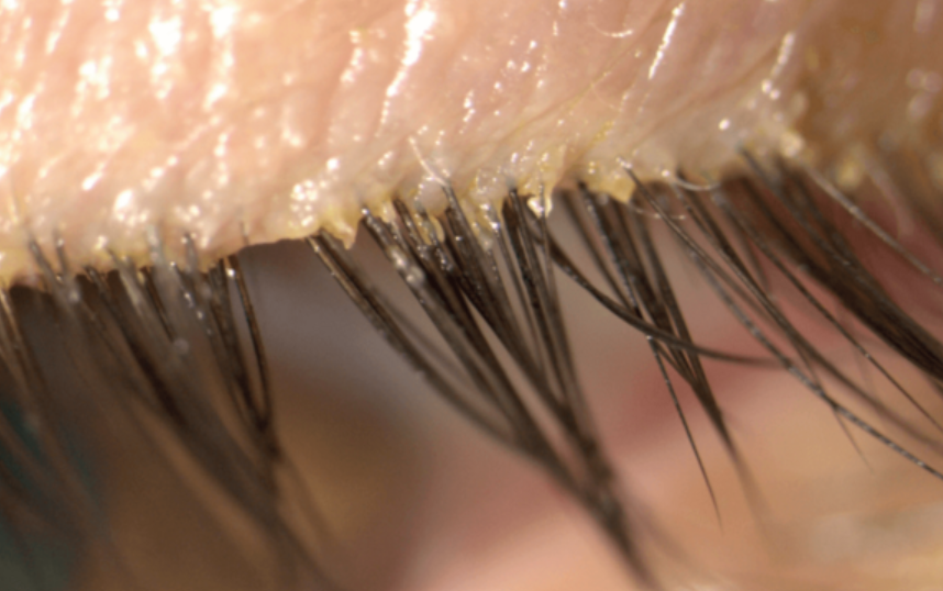 Ce este foliculita infecțioasă și tipurile ei 12 Foliculita cu Demodex la nivelul genelor