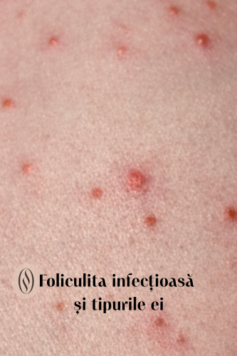 Ce este foliculita infecțioasă și tipurile ei 51 Foliculita infecțioasă și tipurile ei