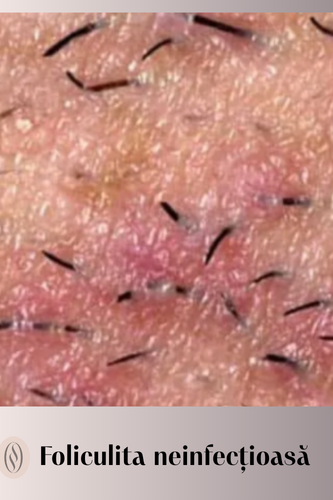 Ce este foliculita neinfecțioasă? 49 Foliculita neinfectioasa 1 uai