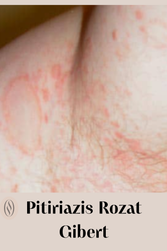 Pitiriazis rozat (Gibert) 47 Pitiriazis rozat Gibert 1 uai