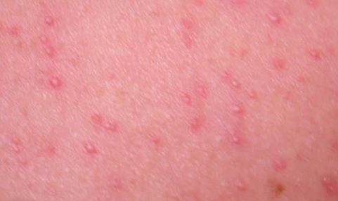 Ce este foliculita infecțioasă și tipurile ei 7 Foliculita cu Malassezia - pustule cu aspect identic