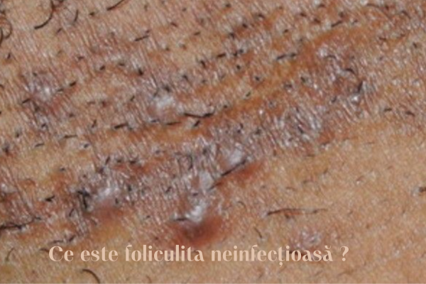 foliculita neinfecțioasă