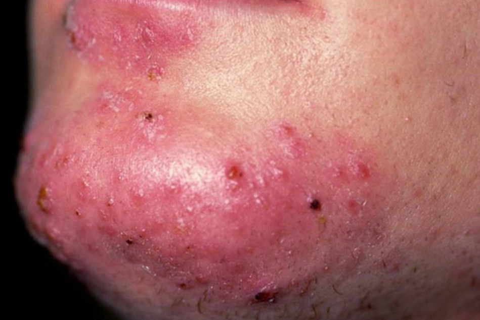 Ce este foliculita infecțioasă și tipurile ei 8 Foliculita cu candida