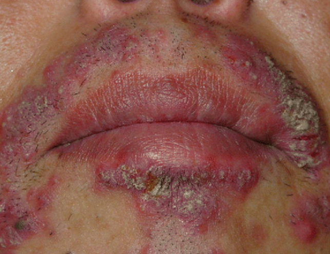 Tratamentul Foliculitei Infecțioase 3 sycosis barbae