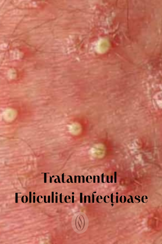 Tratamentul Foliculitei Infecțioase 48 tratamentul foliculitei infectioase