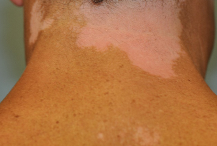Pitiriazis Versicolor (Tinea Versicolor) 8 Pete complet albe in vitiligo