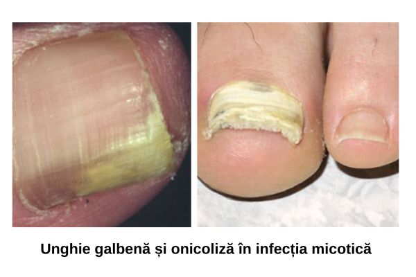 Unghie galbenă și onicoliza în infecția cu Fusarium