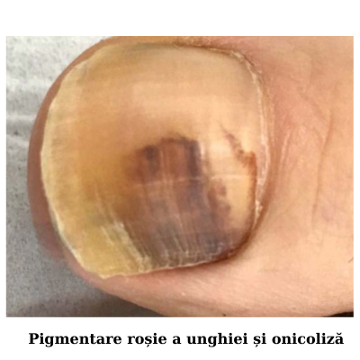 desprinderea placii unghiale